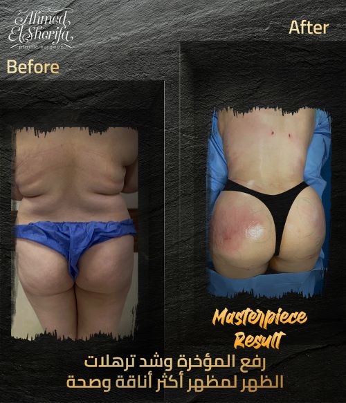 رفع المؤخرة وشد ترهلات الظهر