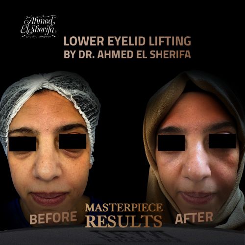 عملية تجميل الجفون