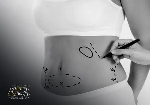 Tummy Tuck surgery after repeated childbirth