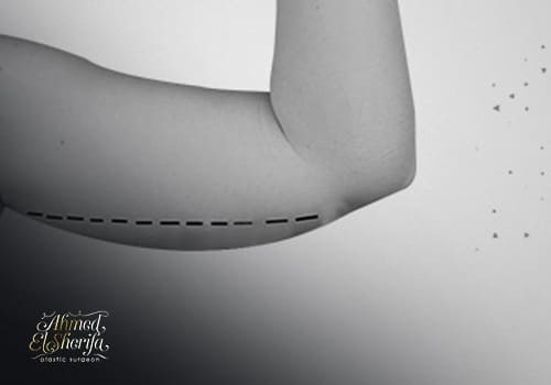 Arm-Lift-for-Sagging-Arms
