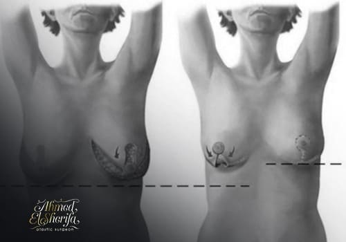 breast reduction breast reduction