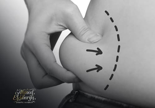 Liposuction and body contouring Liposuction and body contouring