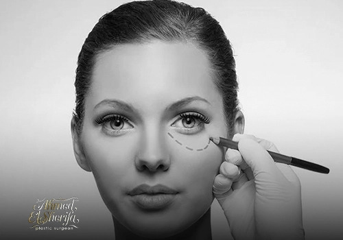 تجميل الجفون في مصر | شد الجفن العلوي والسفلي بدون مبالغة