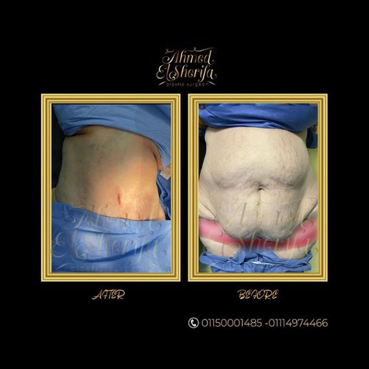 Full Tummy Tuck and strengthening its muscles