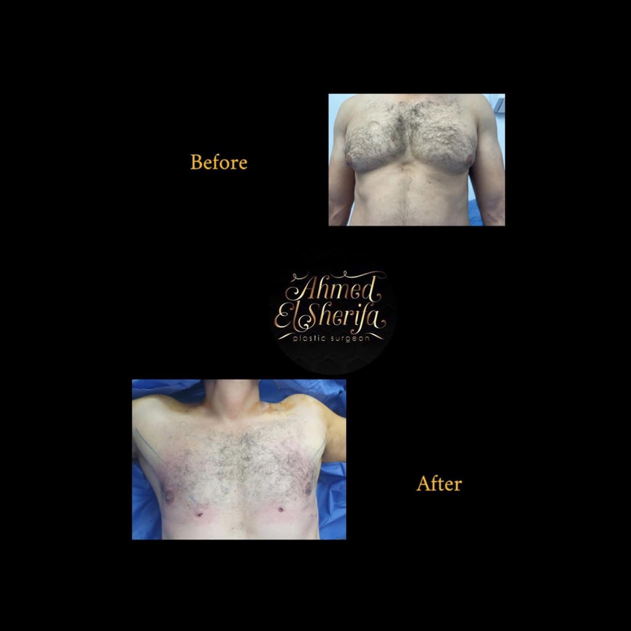 A successful case of gynecomastia in a young athlete