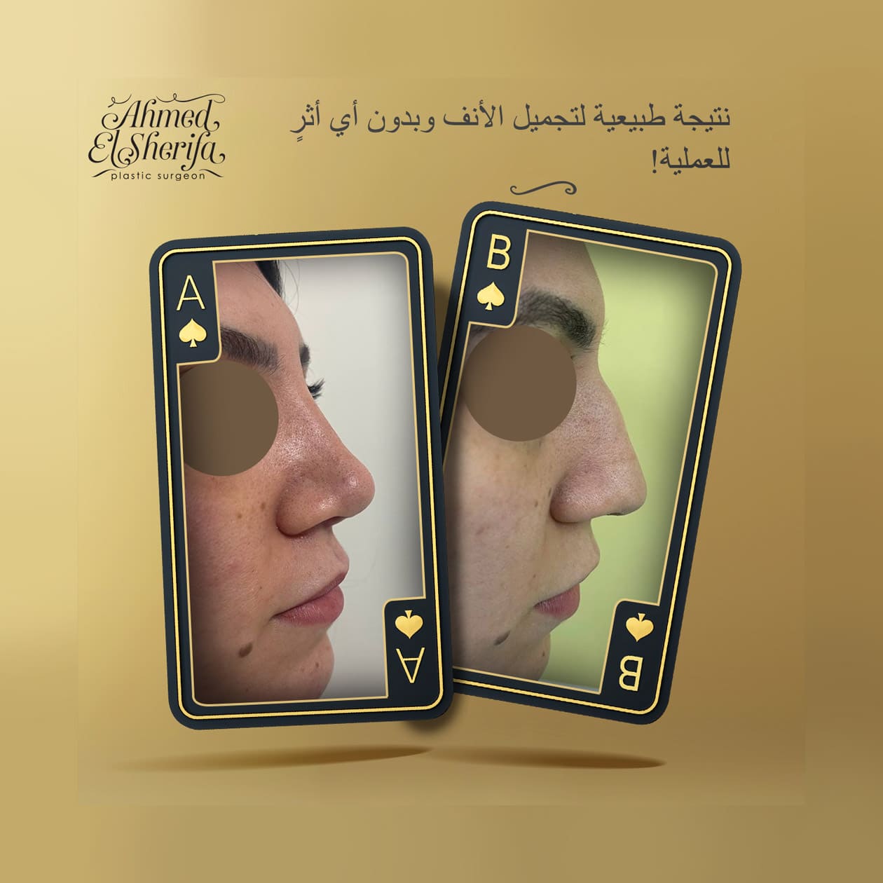 My nose shape changed completely, and I restored my self-confidence