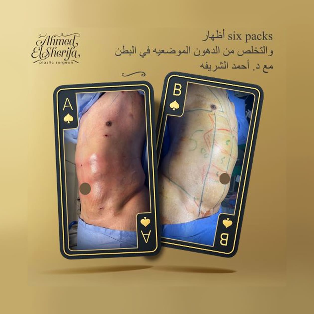 عضلات البطن six pack