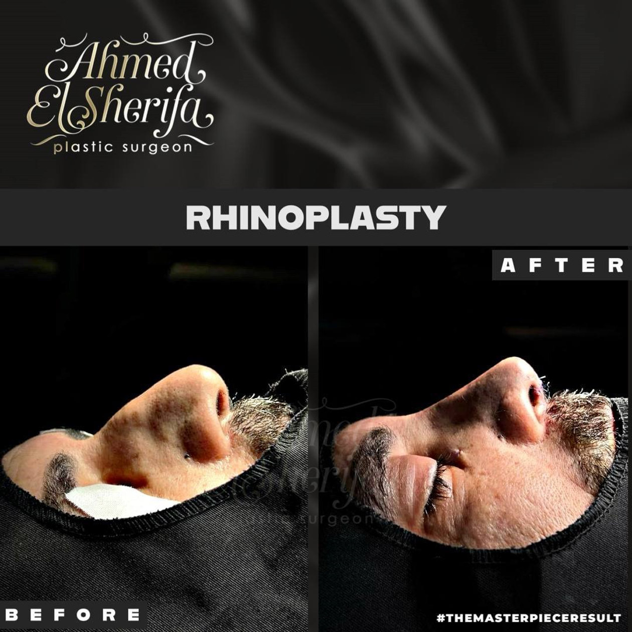 تجربة تجميل الأنف الكاملة من القرار إلى النتائج تجربة تجميل الأنف الكاملة من القرار إلى النتائج