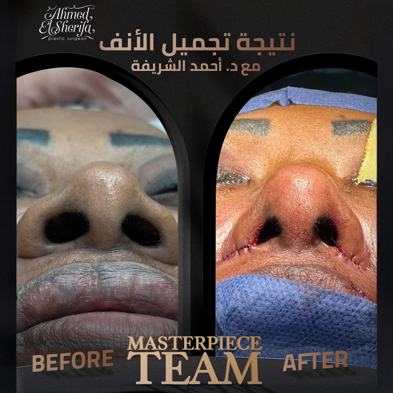 تجربتي مع عملية تجميل الأنف من التردد إلى الثقة بالنفس تجربتي مع عملية تجميل الأنف من التردد إلى الثقة بالنفس
