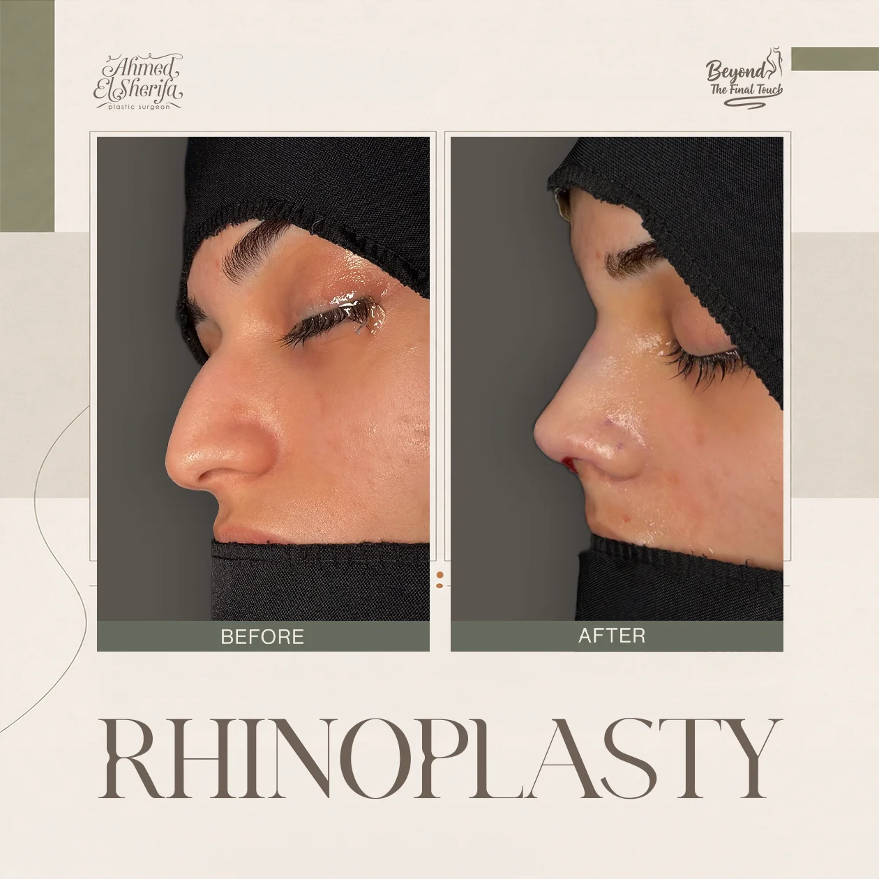 تغيير الشكل بعد عملية تجميل الأنف