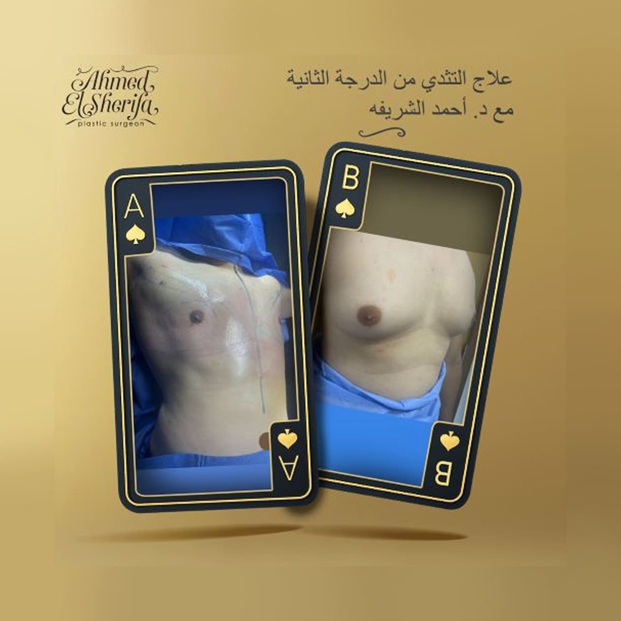 علاج التثدي عند الرجال علاج التثدي عند الرجال