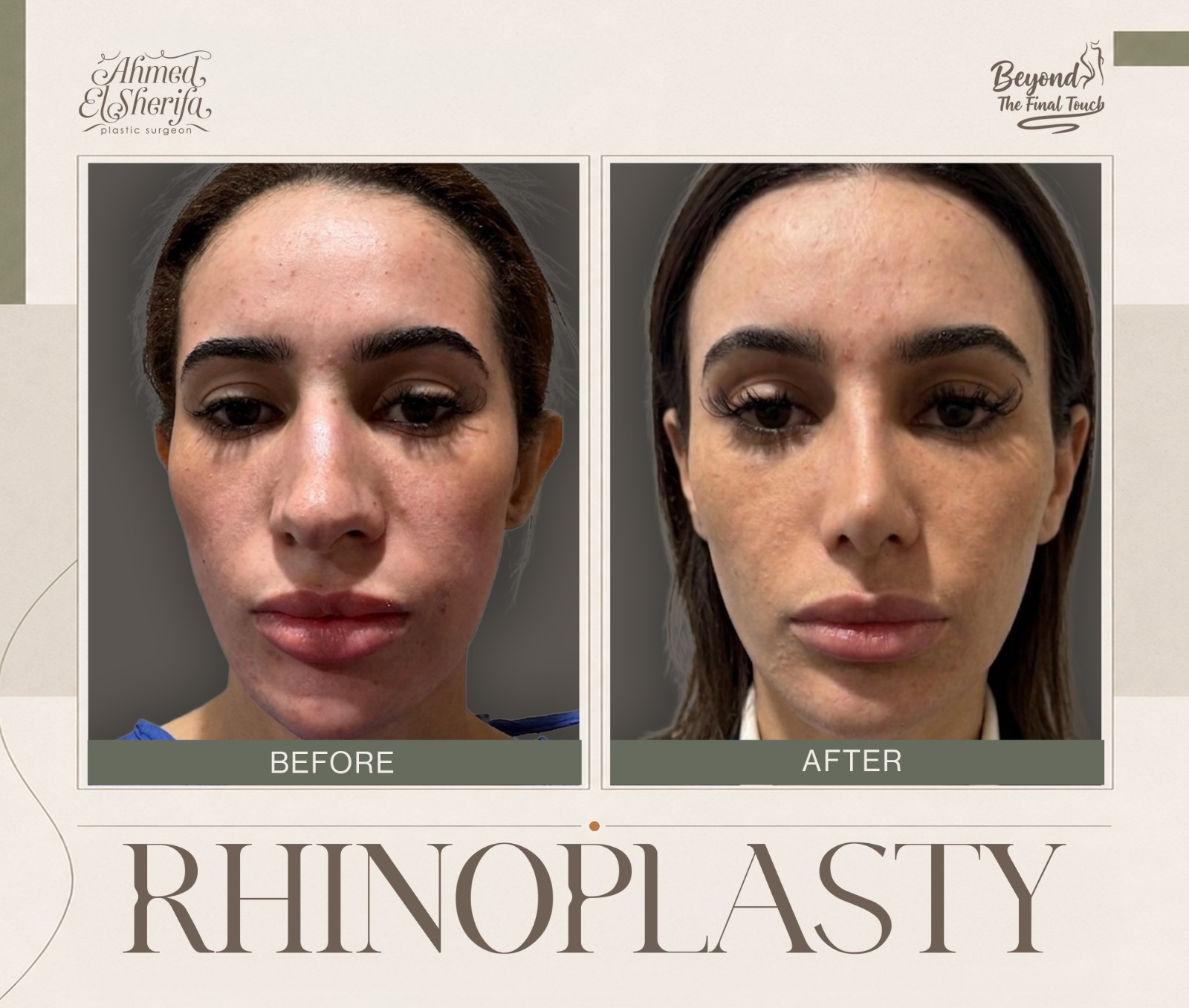 نتيجة رائعة لتجميل الأنف