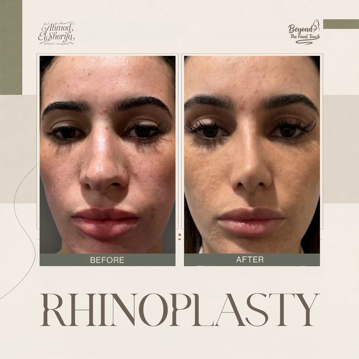 نتيجة رائعة لتجميل الأنف