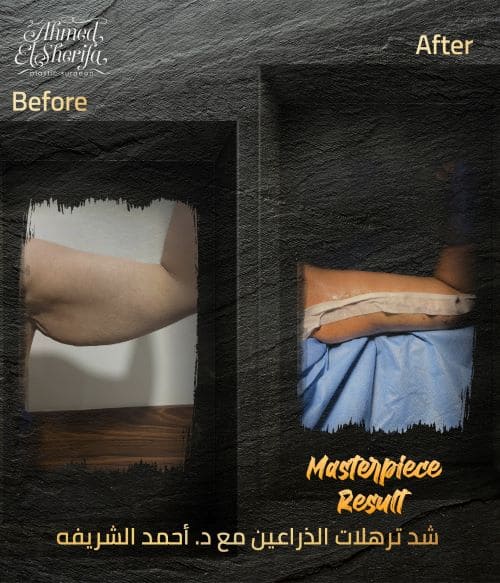 ترهلات الذراعين