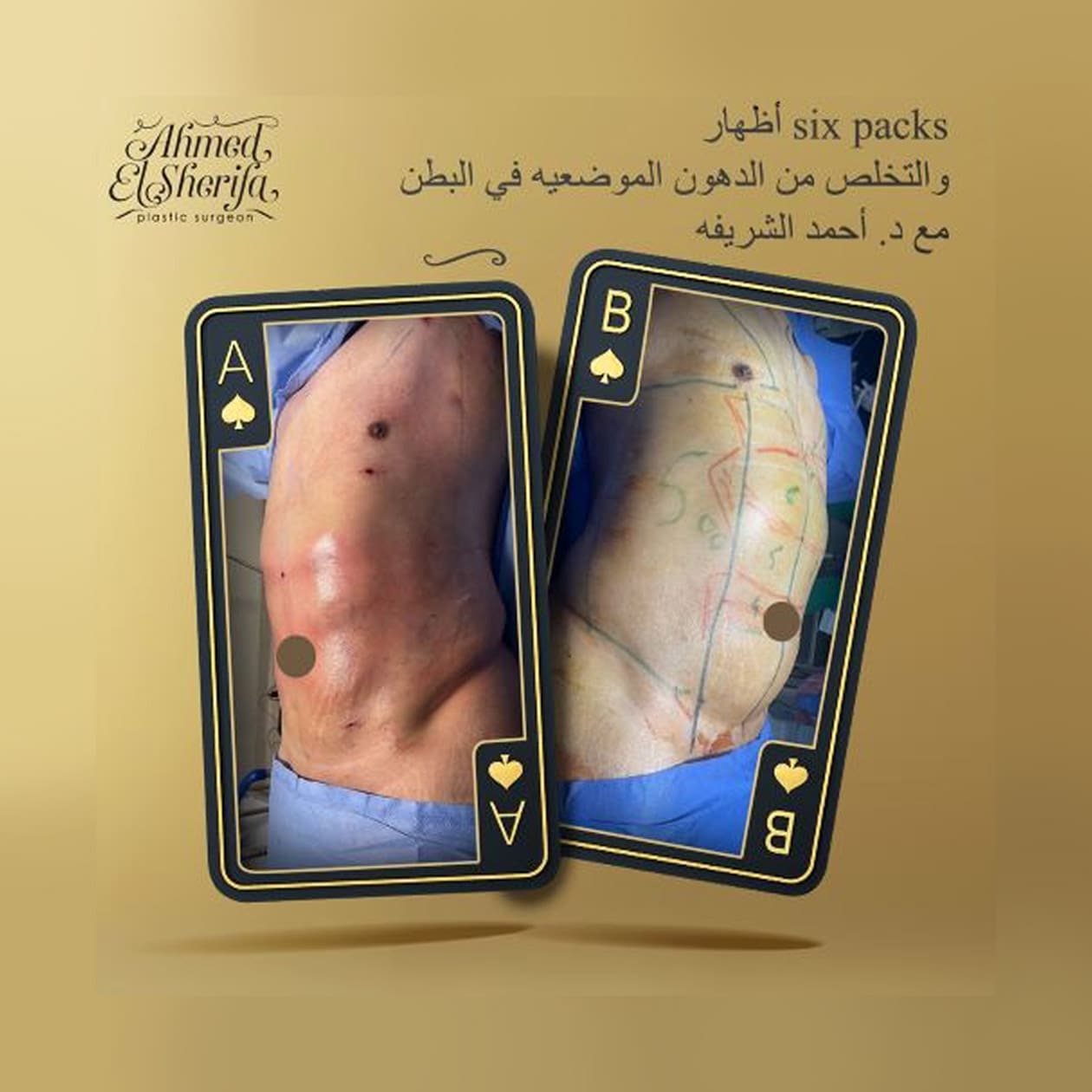 عضلات البطن six pack عضلات البطن six pack