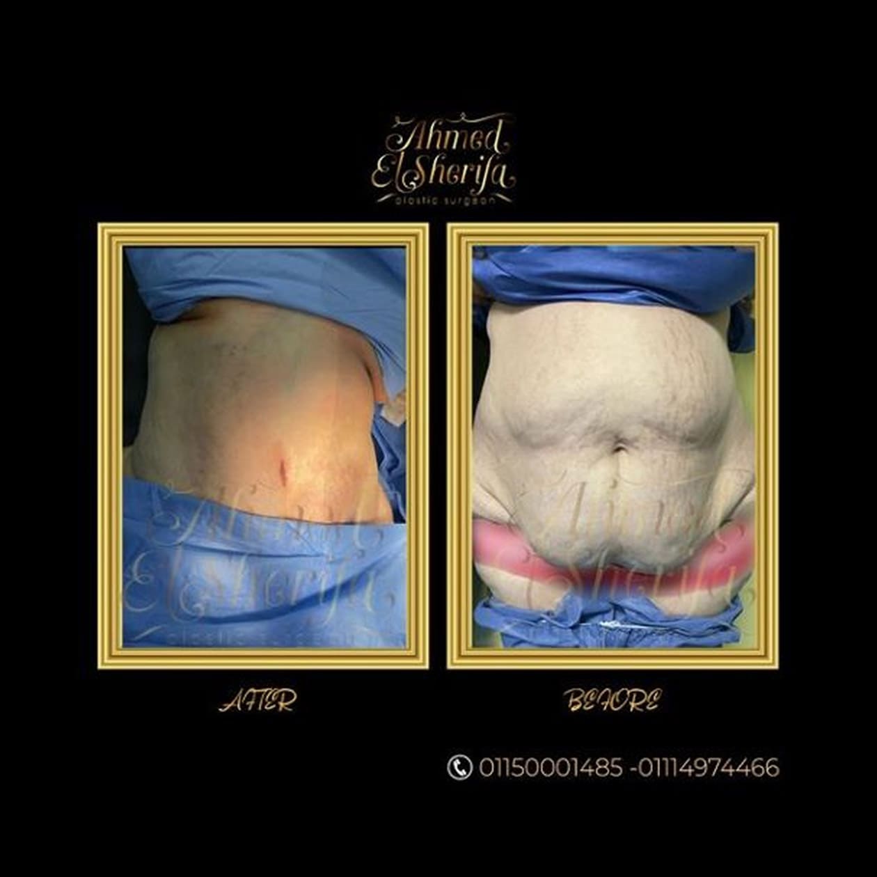 عملية شد البطن tummy tuck عملية شد البطن tummy tuck